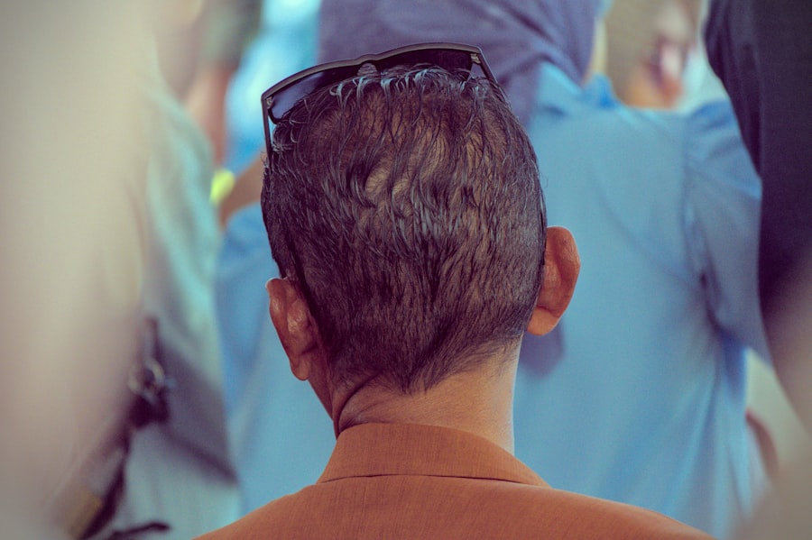 Photo Hair transplant